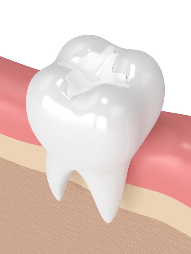 White fillings for teeth